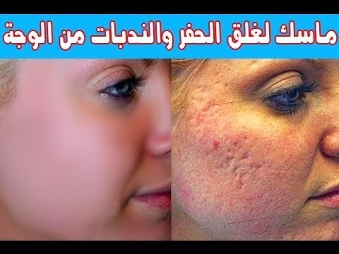 چيل الحلزون والاورجان للقضاء علي التجاعيد💚