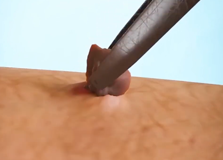 تكلفة العيادات والليز عالية جداً ومقلقة.