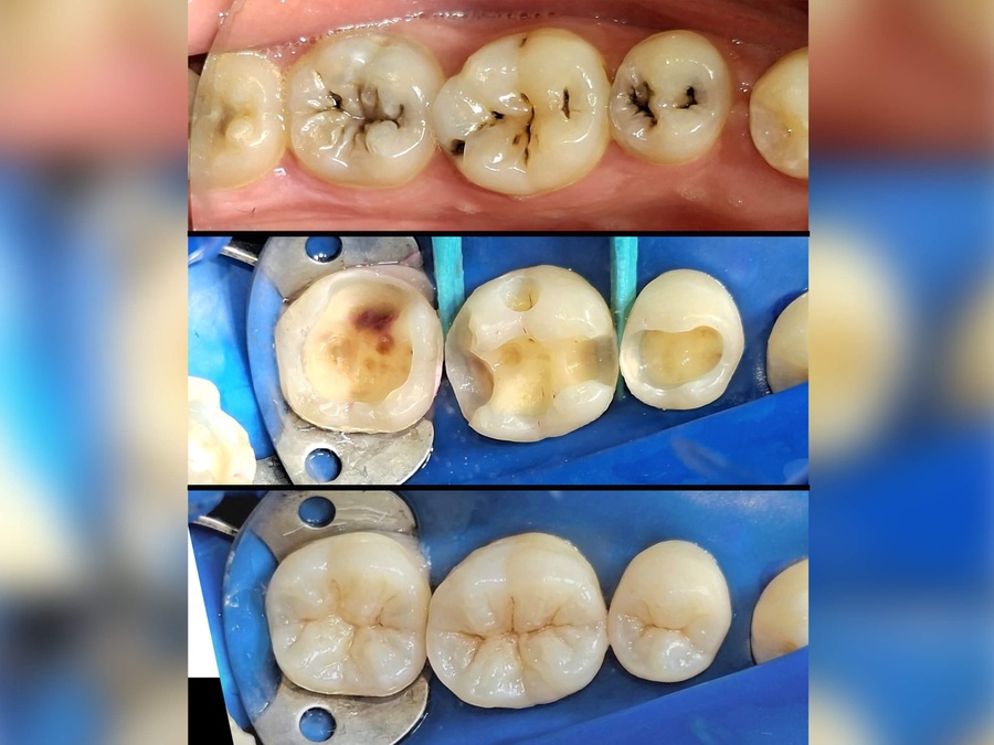 ٍSMITE Flowable composite  nano-ceramic hybrid