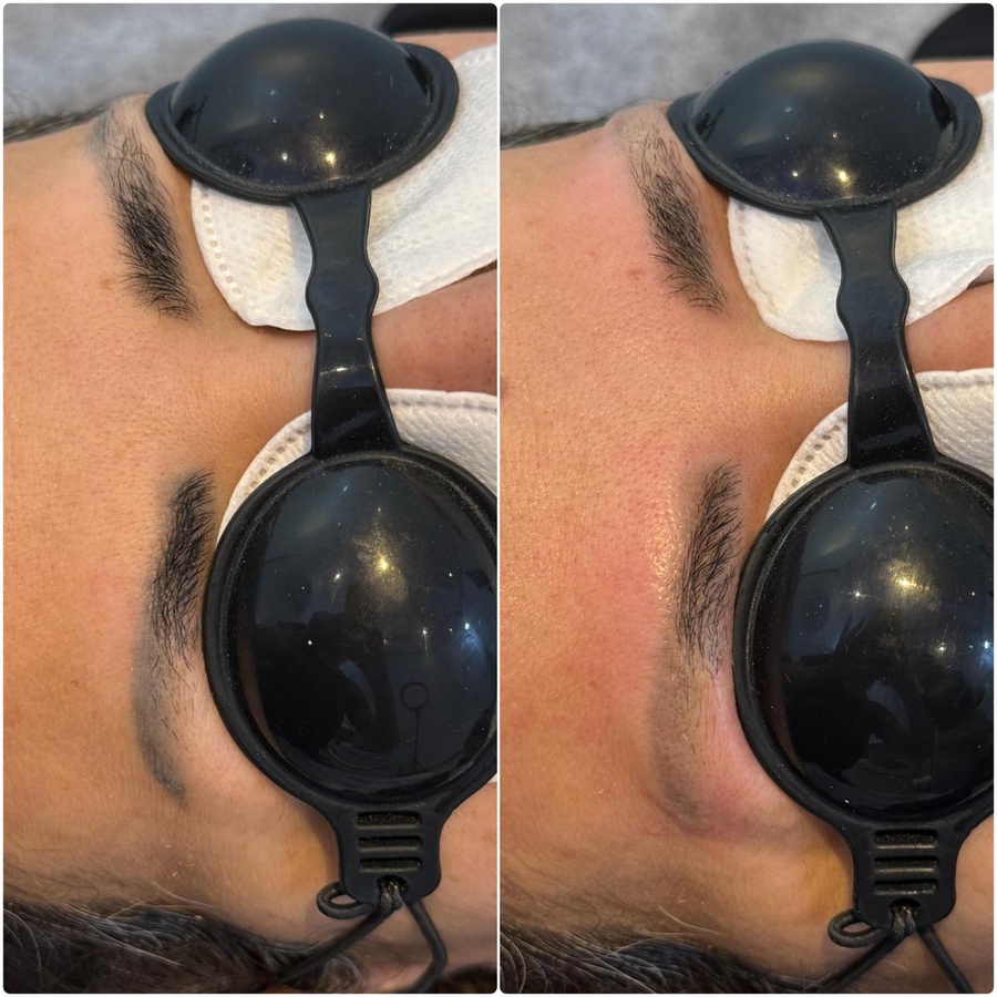 استعادة الحواجب الطبيعية ✨ (Natural Eyebrow Restoration)