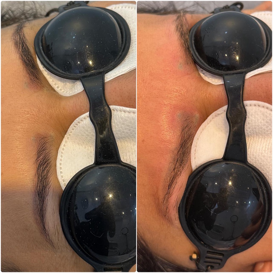 استعادة الحواجب الطبيعية ✨ (Natural Eyebrow Restoration)