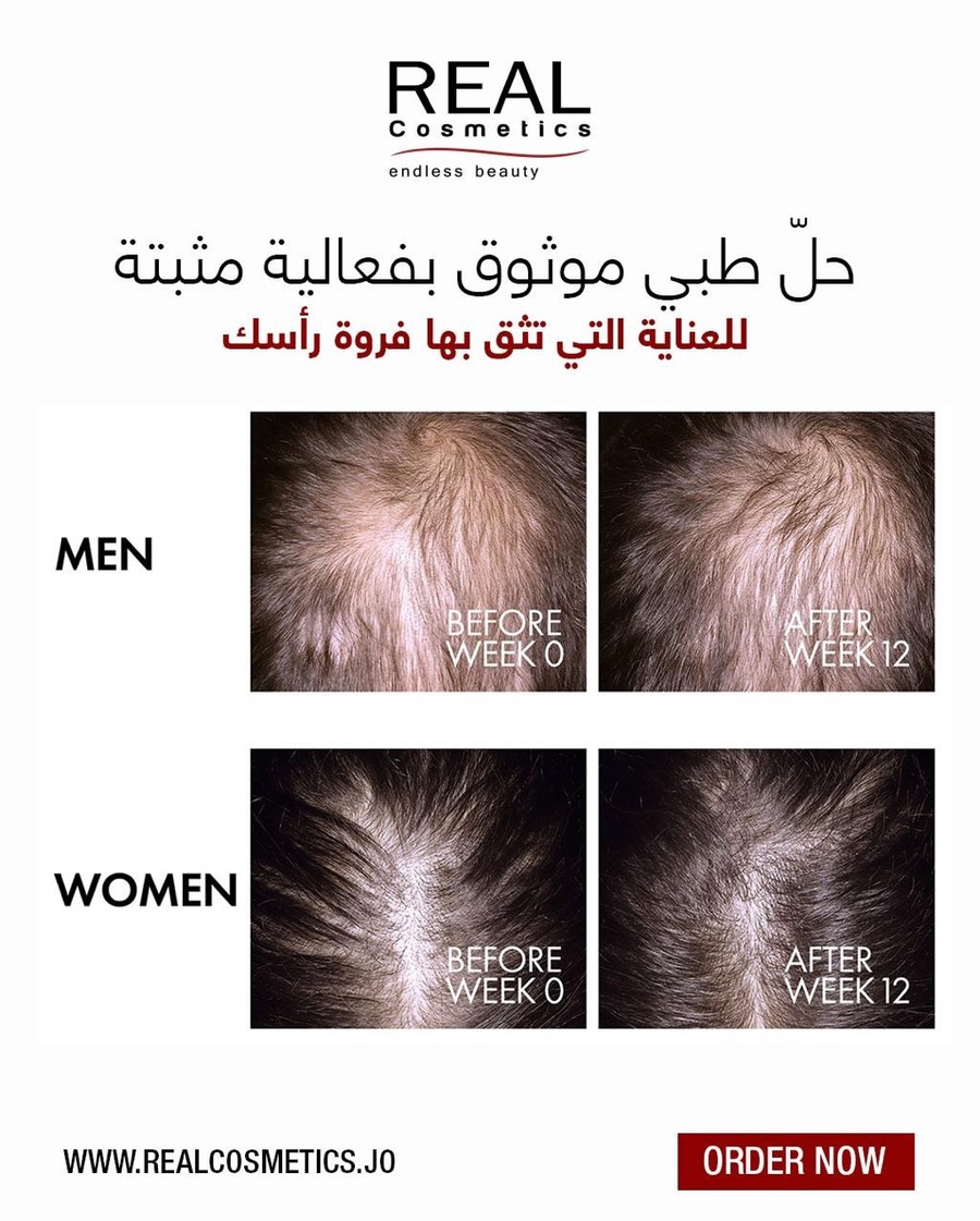 سيروم فيشي ديركوس أمينيكسيل ريجين بوستر لعلاج تساقط الشعر وتكثيفه 90 مل