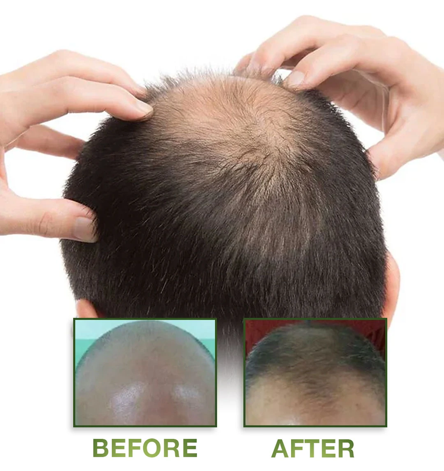 بخاخ نيو هير للعناية بالشعر وفروة الرأس 120 مل – New Hair Lotion Treatment