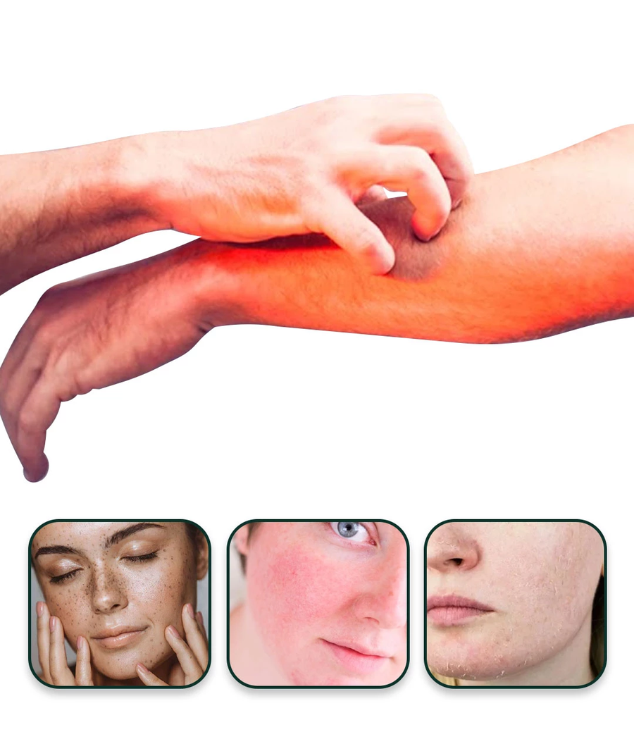 Skin Tinea Care External Cream - كريم عشبي للعناية بالبشرة