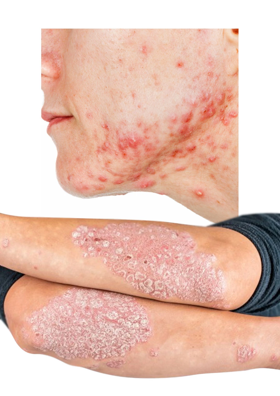 Skin Tinea Care External Cream - كريم عشبي للعناية بالبشرة