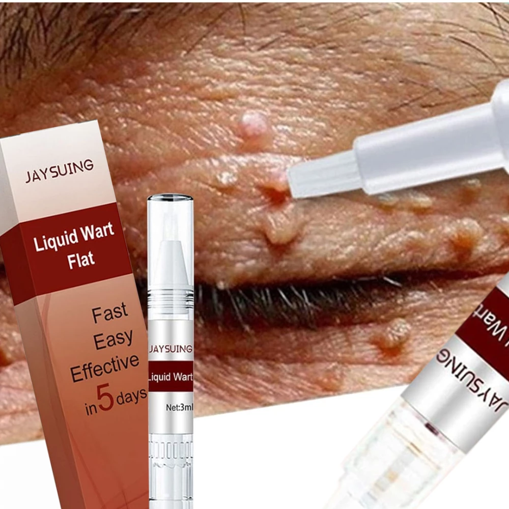 قلم إزالة الثآليل والزوائد الجلدية Skin Tag Remover and Wart Removal Pen سعة 3 مل