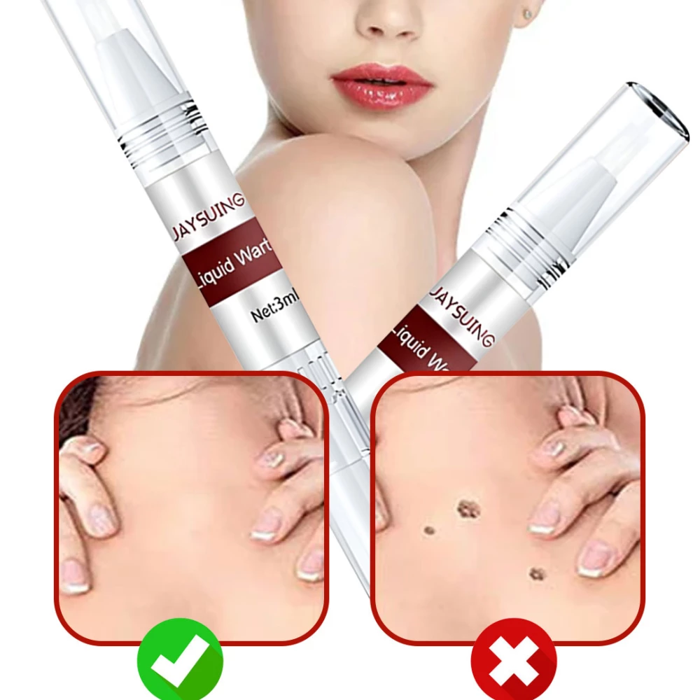 قلم إزالة الثآليل والزوائد الجلدية Skin Tag Remover and Wart Removal Pen سعة 3 مل