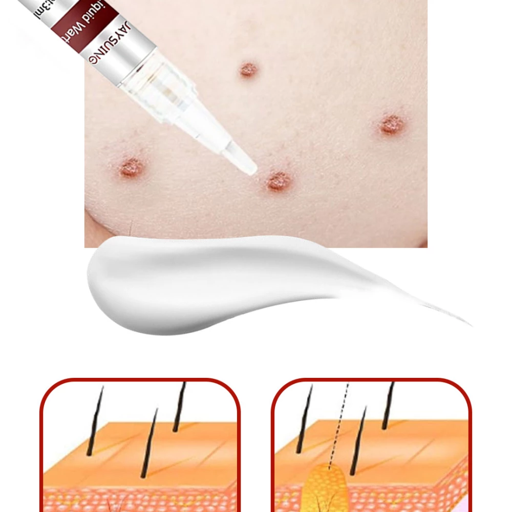 قلم إزالة الثآليل والزوائد الجلدية Skin Tag Remover and Wart Removal Pen سعة 3 مل