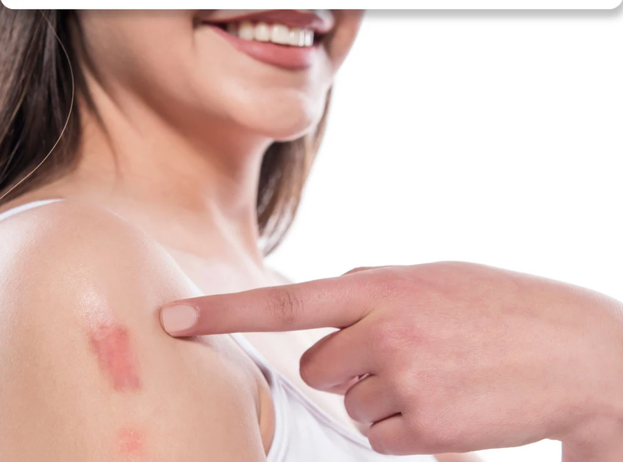 بخاخ مزيل الندبات Advanced Scar Removal Spray للعناية بمظهر الندبات والبقع الداكنة 20 جرام