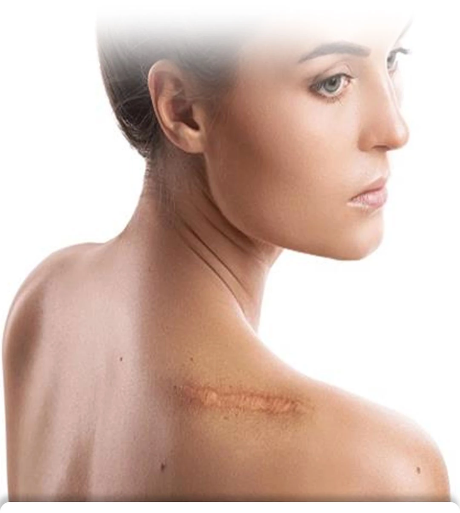 بخاخ مزيل الندبات Advanced Scar Removal Spray للعناية بمظهر الندبات والبقع الداكنة 20 جرام