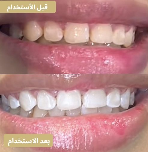 حتى الأسنان الأمامية صارت أنصع