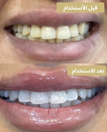 ابتسامة بيضاء من غير عيادة